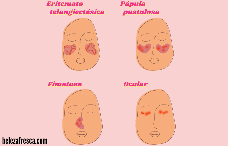 Imagem de rosácea com os graus de rosácea e as carcterísticas dos subtipos